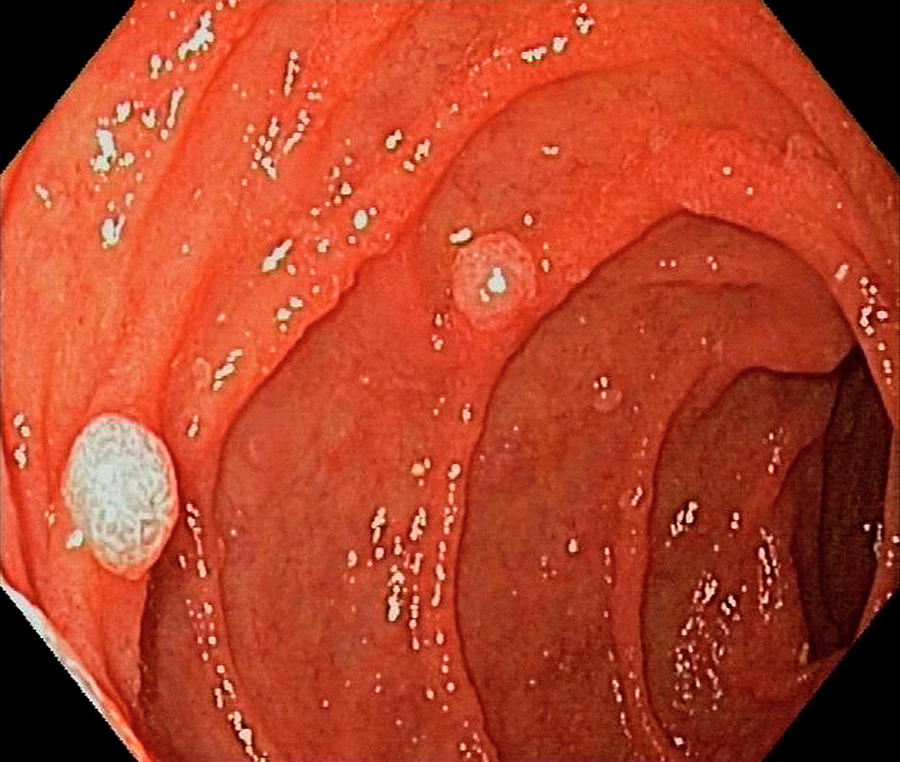 Abnormal Photograph - Duodenal Polyps by Gastrolab