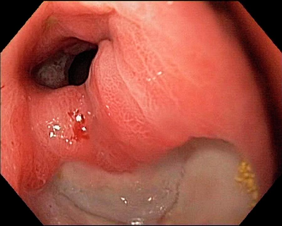 Duodenal Ulcer Photograph by Gastrolab/science Photo Library