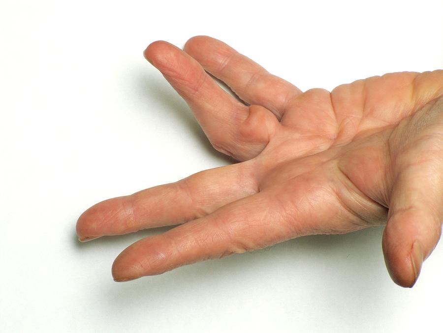 Dupuytrens Contracture By Alex Bartelscience Photo Library