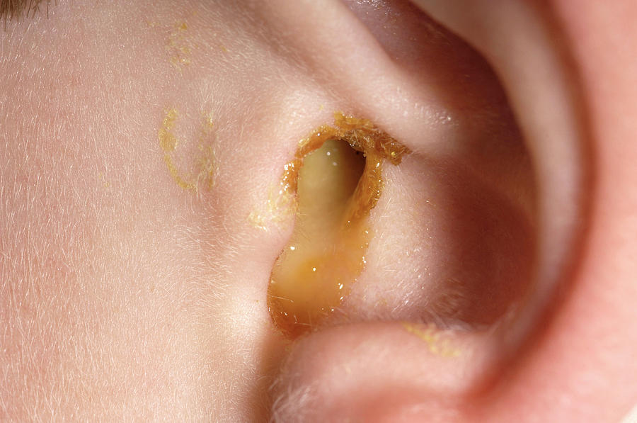 Picture Of An Ear Infection