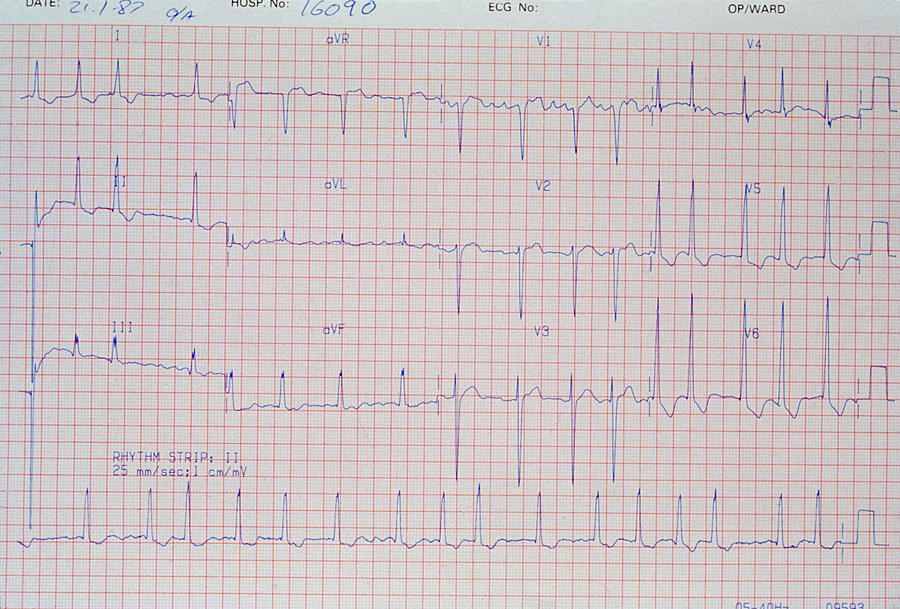 Ecg Showing Aortic Stenosis. Photograph by Science Photo Library - Pixels