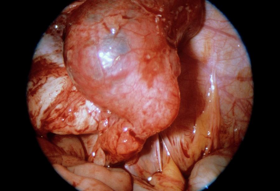 Endoscope Photograph - Ectopic Pregnancy by Dr J. P. Abeille/science Photo Library