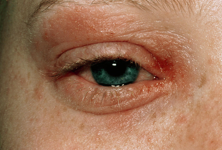 Eczema Around Eye Of A Patient Photograph by Dr P. Marazzi/science