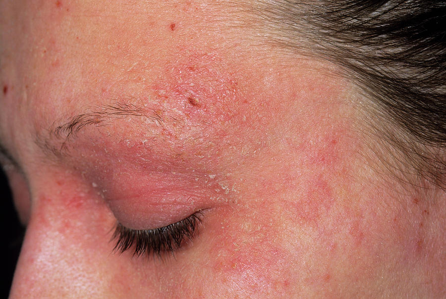 Eczema On A Girl's Face Photograph by Dr P. Marazzi/science Photo Library