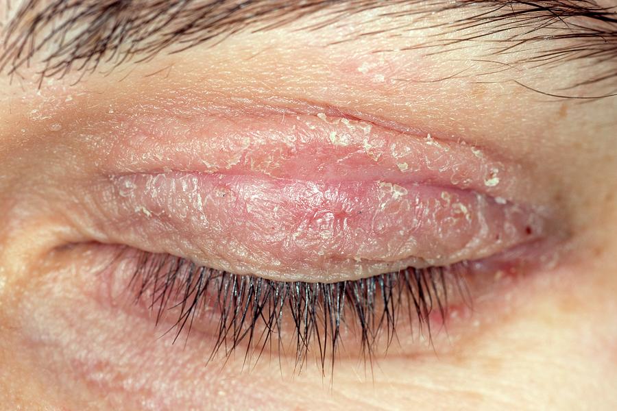 Eczema On Eyelid Photograph By Dr P Marazziscience Photo Library