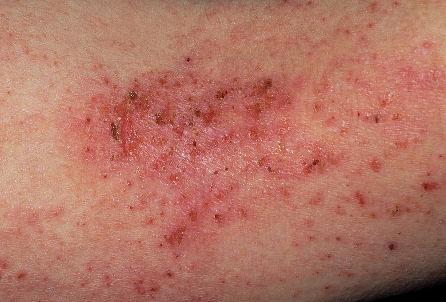 Eczema Rash Photograph By Dr P Marazziscience Photo Library