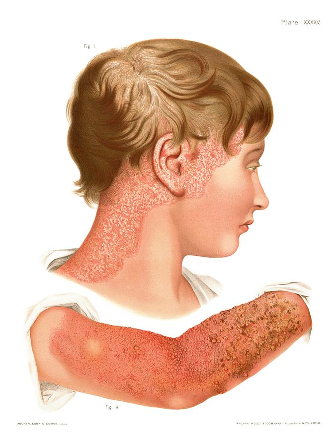 Eczema Photograph by Us National Library Of Medicine/science Photo Library