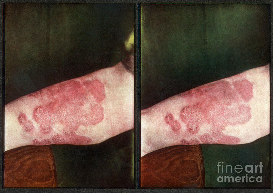 Eczema, Vintage Stereoscopic Image Photograph by DoubleVision