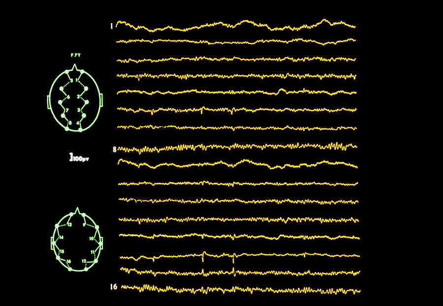 Eeg In Epilepsy: Intermittent Focal Spikes Photograph by Science Photo Library