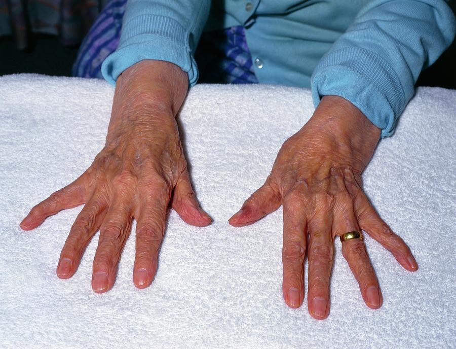 Elderly Ladies Arthritic Hands Spread Out Photograph by Mark Allan ...