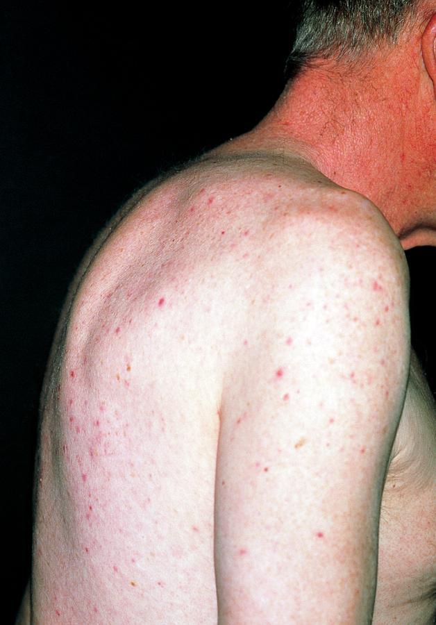 Elderly Man Suffering From Severe Kyphosis Photograph by Dr P. Marazzi ...