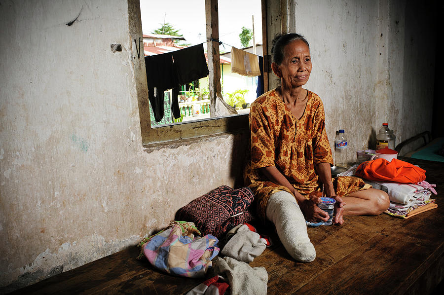 Elderly Woman With Leprosy Photograph by Matthew Oldfield