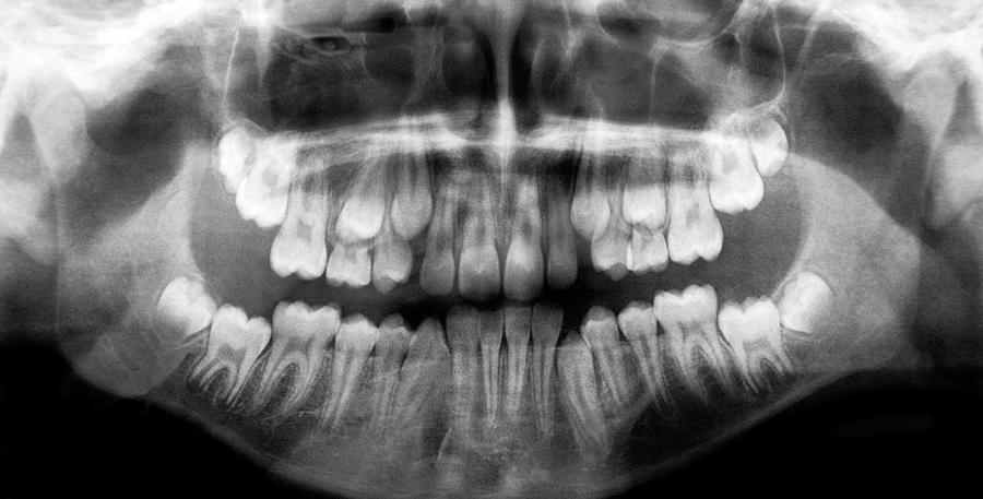 Emergence Of Adult Teeth Photograph by Aj Photo/science Photo Library ...