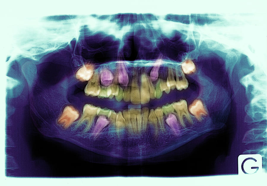 Emergence Of Adult Teeth Photograph by Alex Bartel/science Photo Library