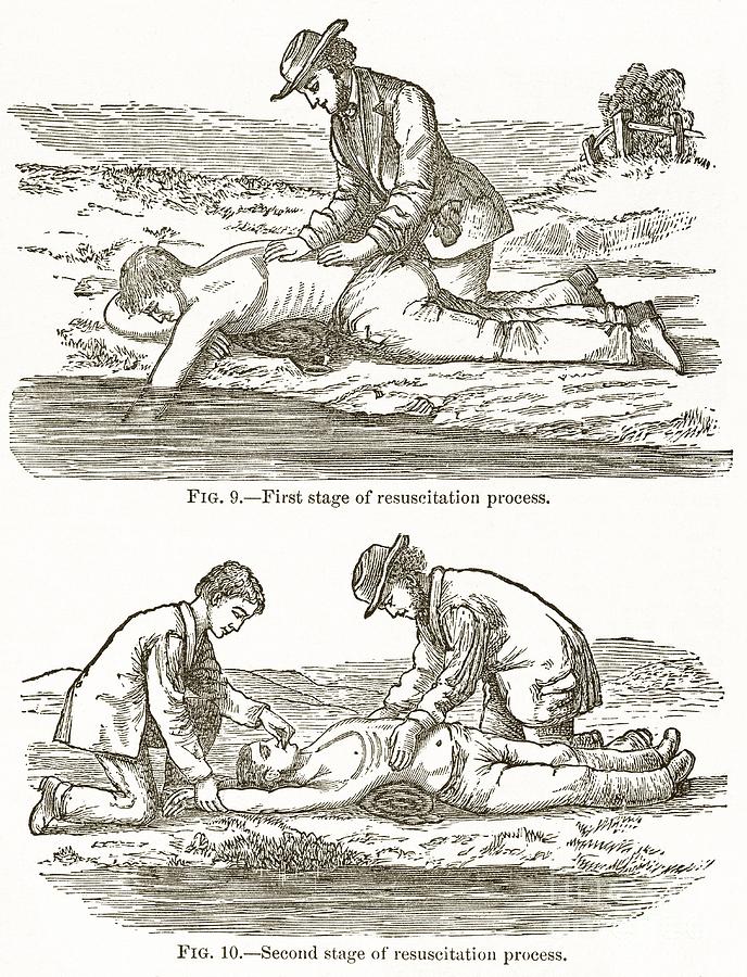 Cardiopulmonary Resuscitation Photograph - Emergency Resuscitation, 19th Century by Middle Temple Library