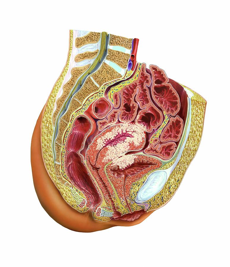 Endometrial Cancer Photograph By Bo Veisland Science Photo Library Pixels