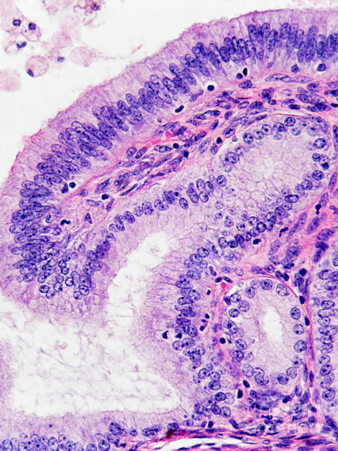 Endometrial Cancer, Lm Photograph by Garry DeLong