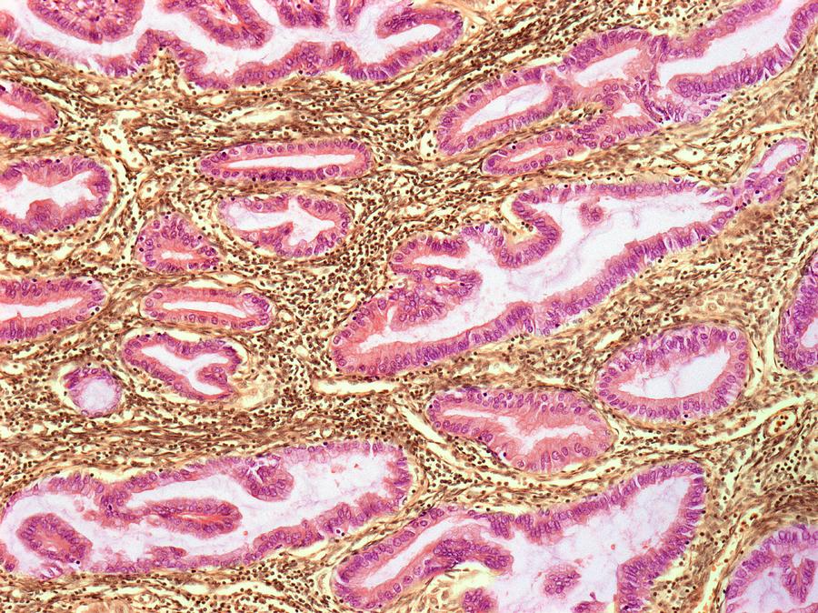 Endometrial Hyperplasia Photograph by Steve Gschmeissner - Pixels