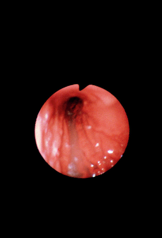 Fundus Photograph - Endoscope Image Of Normal Fundus Of Stomach by Cnri/science Photo Library
