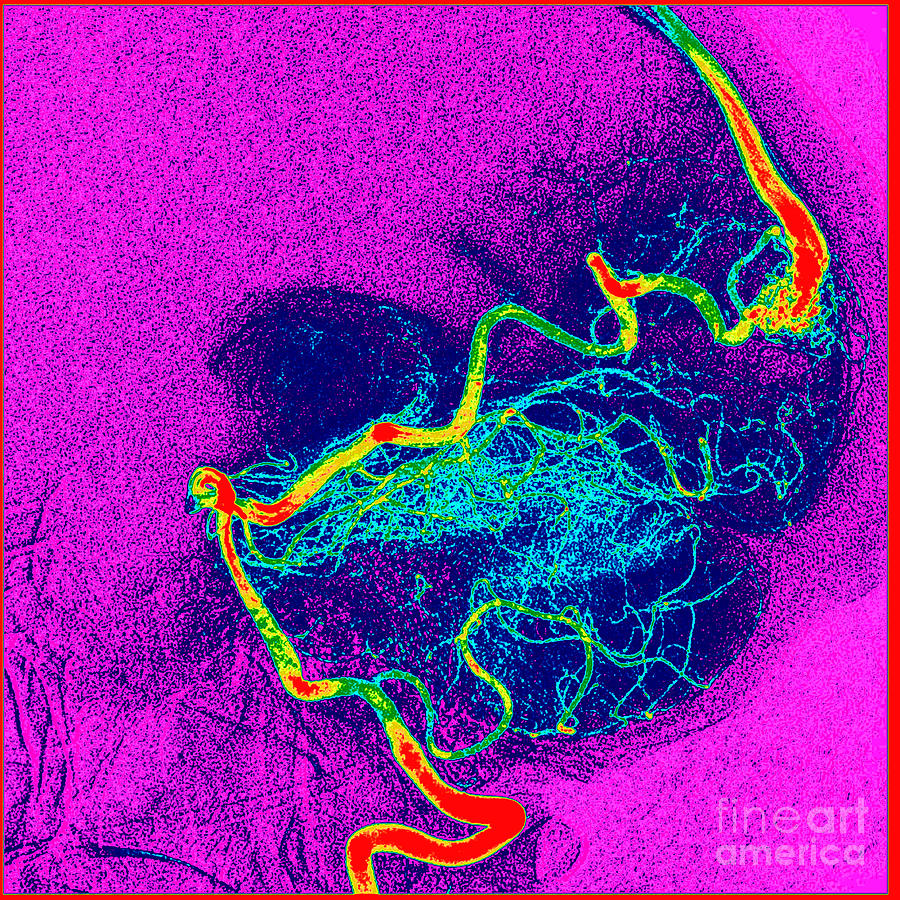 Enhanced Cerebral Angiogram Photograph by Living Art Enterprises, LLC