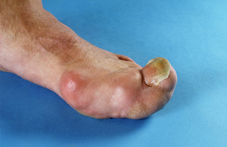 Enlarged Big Toe Photograph by Mike Devlin/science Photo Library