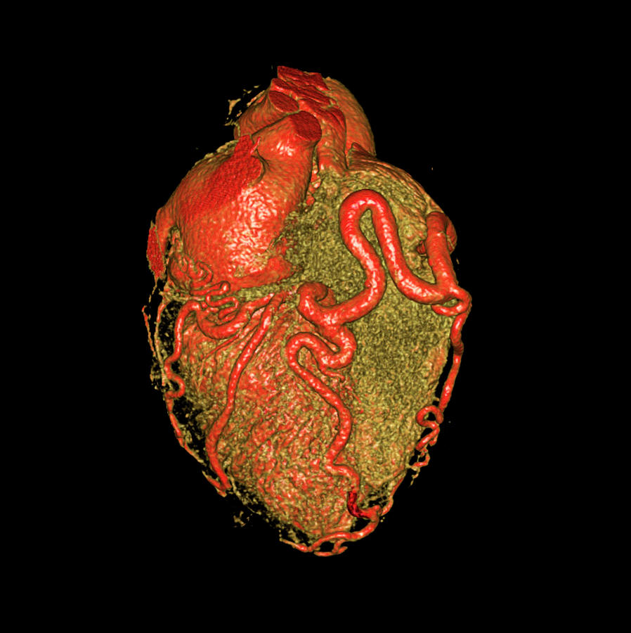 Heart Photograph - Enlarged Coronary Arteries by Antoine Rosset/science Photo Library