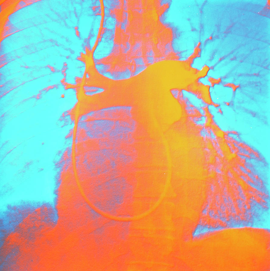 Angiogram Photograph - Enlarged Heart by Sheila Terry/science Photo Library