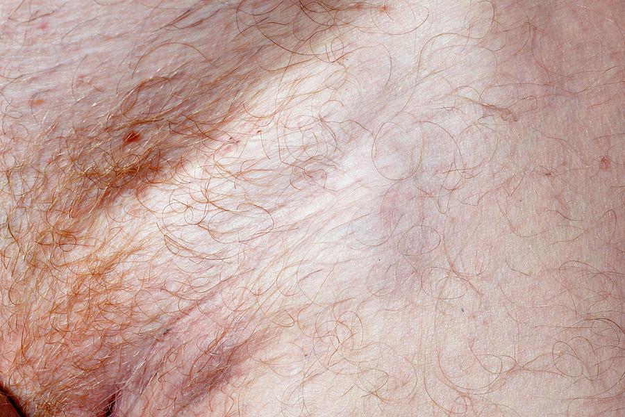 swollen lymph nodes in groin male