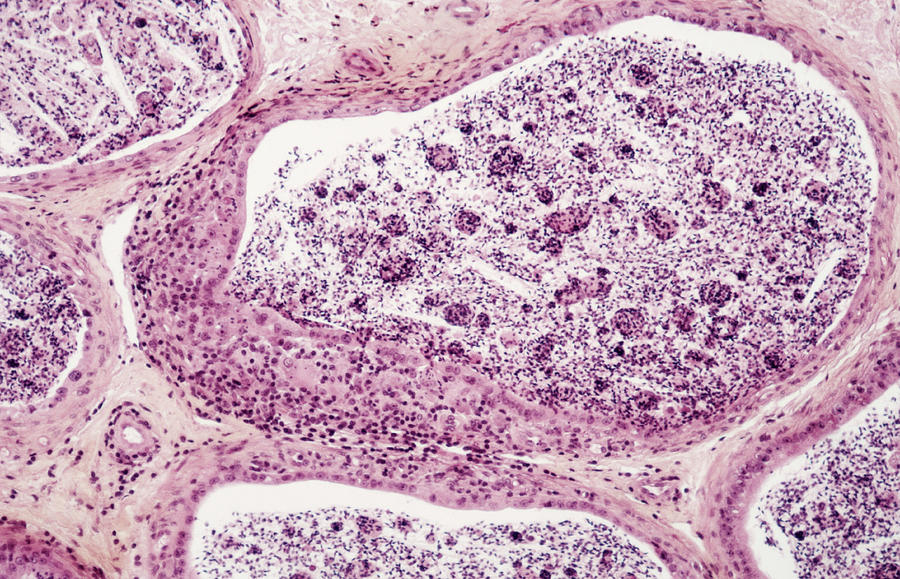 Epididymis Inflammation By Cnri Science Photo Library