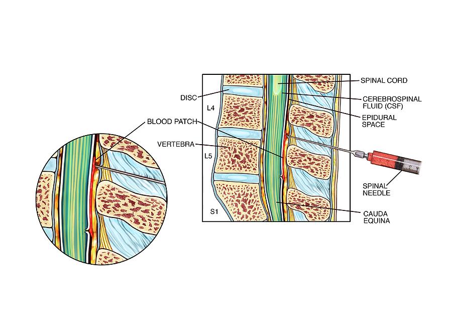 epidural-blood-patch-photograph-by-john-t-alesi