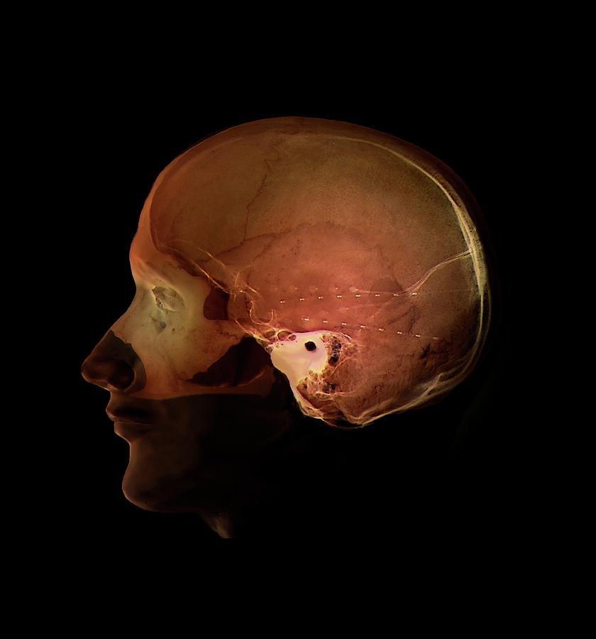 Epilepsy Electrode Implants Photograph by Zephyr/science Photo Library Pixels