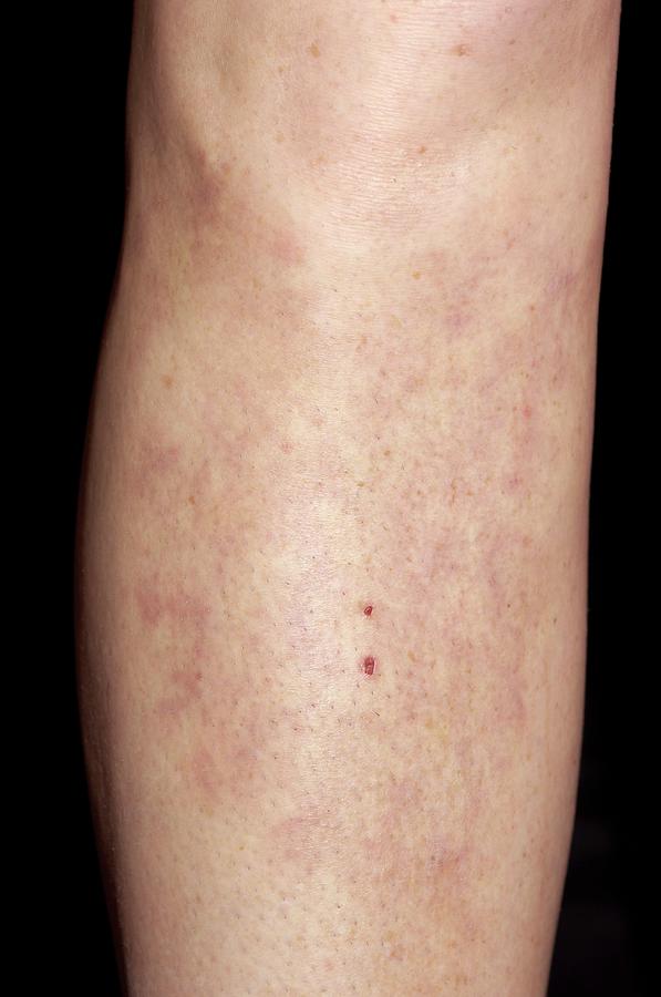 Erythema Nodosum Rash Photograph By Dr P Marazziscience Photo Library