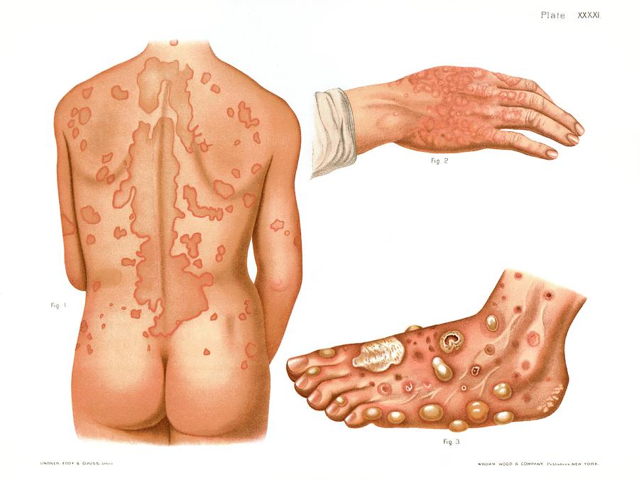 Erythema Photograph by Us National Library Of Medicine/science Photo Library