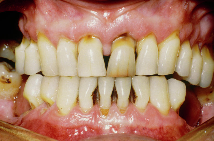 Teeth Photograph - Excessive Brushing Of Teeth by Science Photo Library.