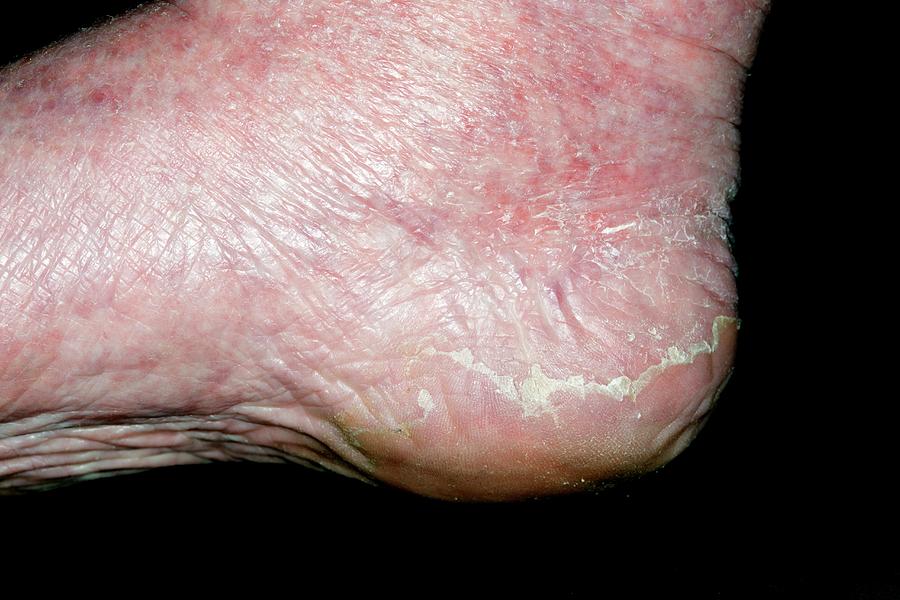 Exfoliative Dermatitis On The Foot Photograph By Dr P Marazziscience Photo Library