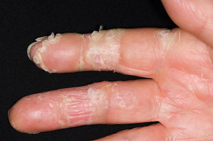 Exfoliative Dermatitis On The Hand Photograph By Dr P Marazzi Science