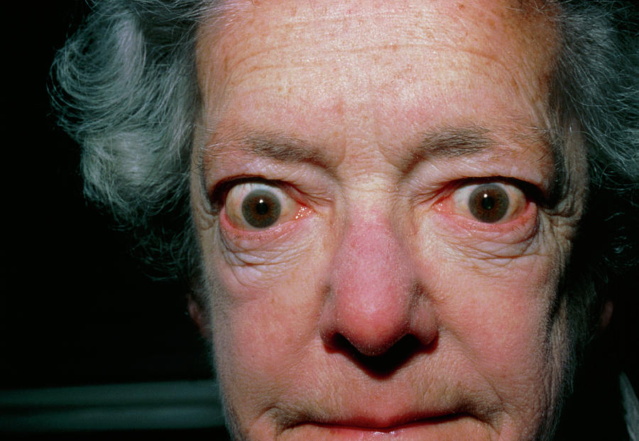 greys disease bulging eyeballs