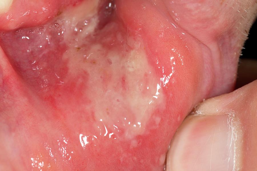 Extensive Mouth Ulcer Photograph By Dr P Marazzi science Photo Library