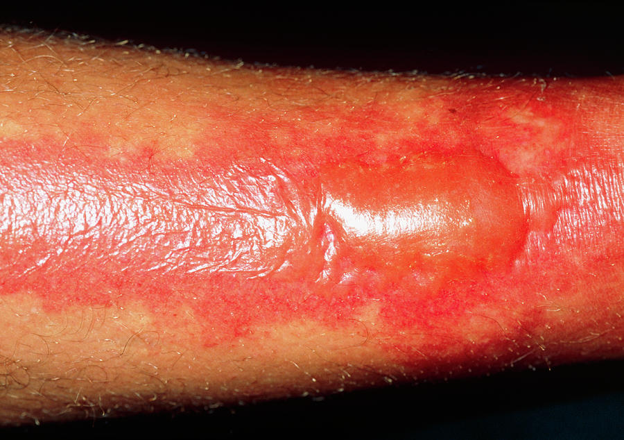 example of second degree burn