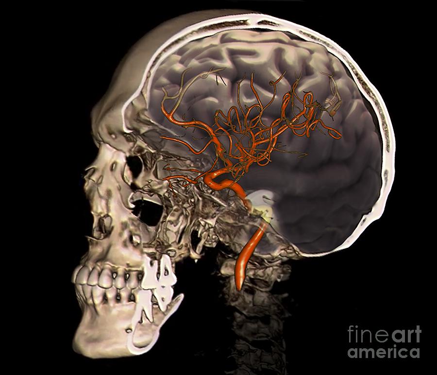 External Carotid Artery, 3d Ct Scan Photograph by Zephyr | Fine Art America