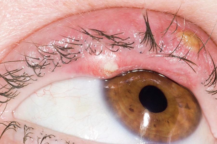 Eye Abscesses Photograph by Dr P. Marazzi/science Photo Library