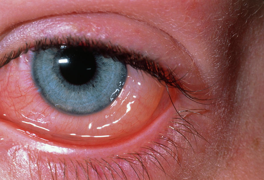 Eye Allergic Conjunctivitis And Conjunctival Oedema Photograph By Dr P Marazziscience Photo Library 