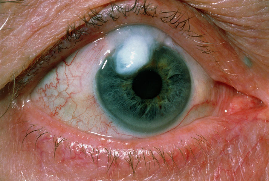 Eye Bleb On Elderly Patient After Eye Surgery Photograph By Science ...