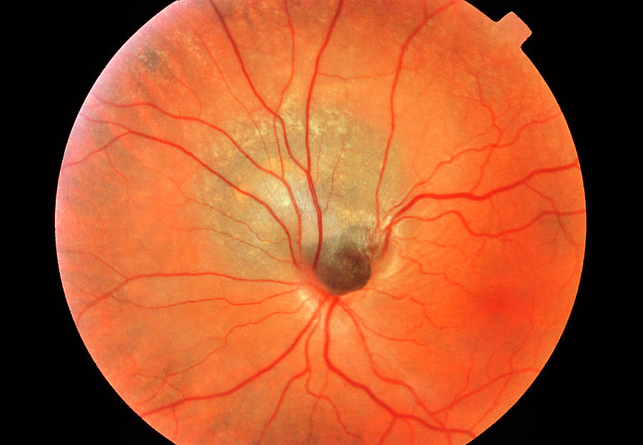 Eye Cancer Photograph by Sue Ford/science Photo Library