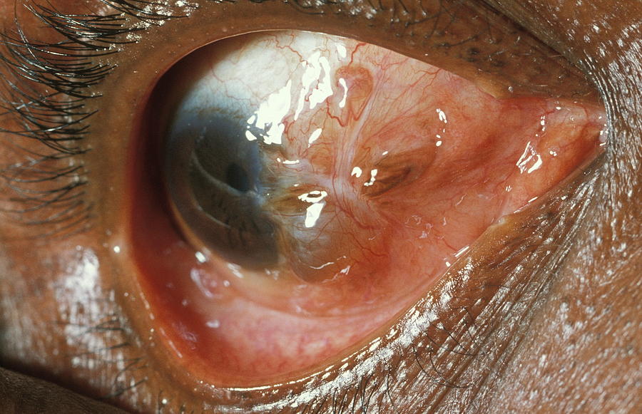 Eye Cyst Photograph by Dr M.a. Ansary/science Photo Library