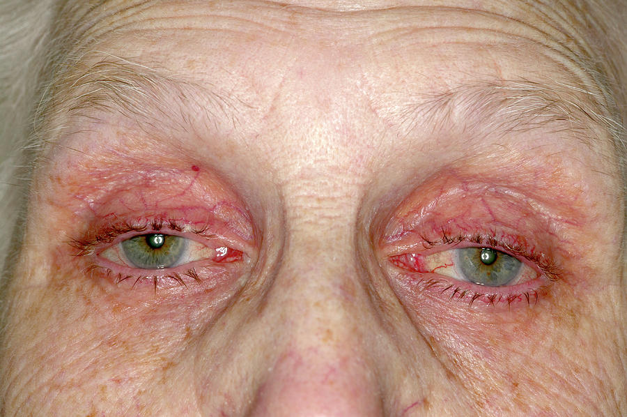 Eye Drop Allergy Photograph By Science Photo Library 5826