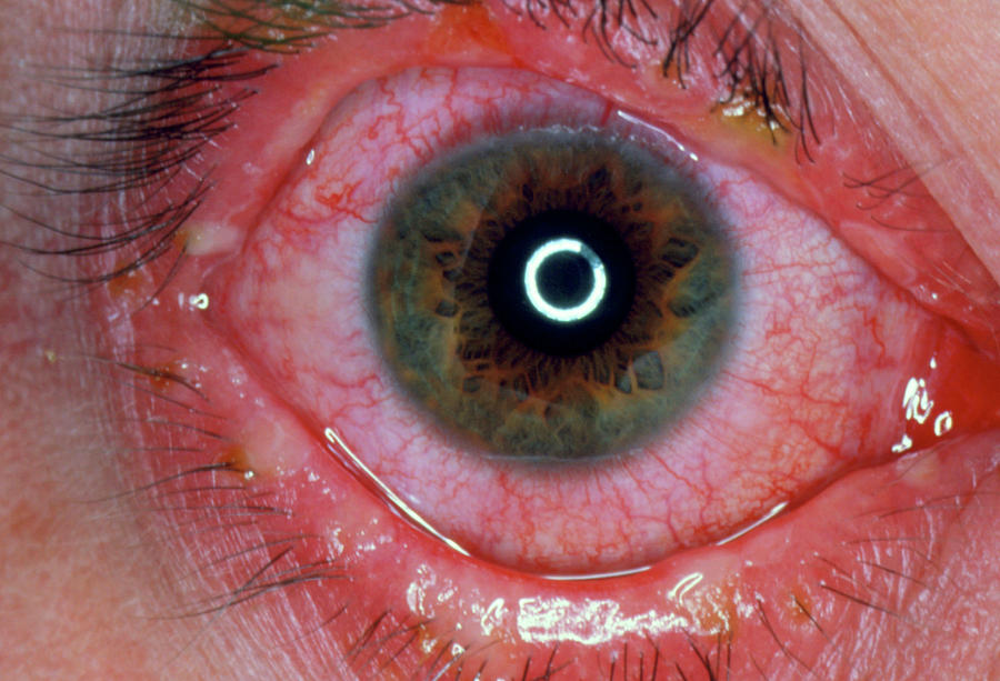 Eye With Conjunctivitis Photograph By Science Photo Library