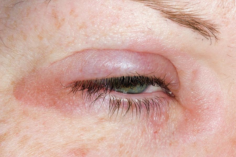 eyelid-swelling-due-to-allergy-photograph-by-dr-p-marazzi-science