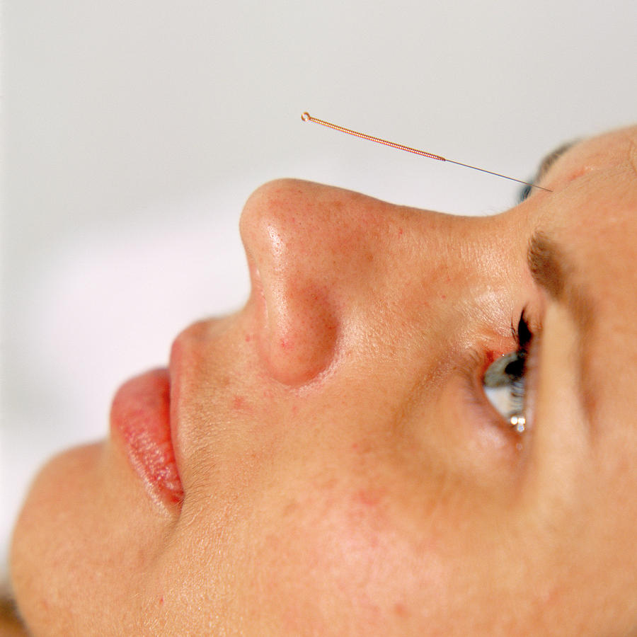 Facial Acupuncture Photograph by Mark Thomas/science Photo Library