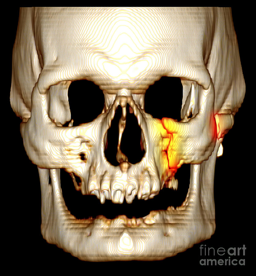 Facial Fractures, Ct Scan Photograph by Scott Camazine